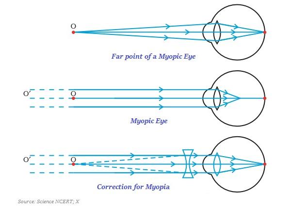 Myopia